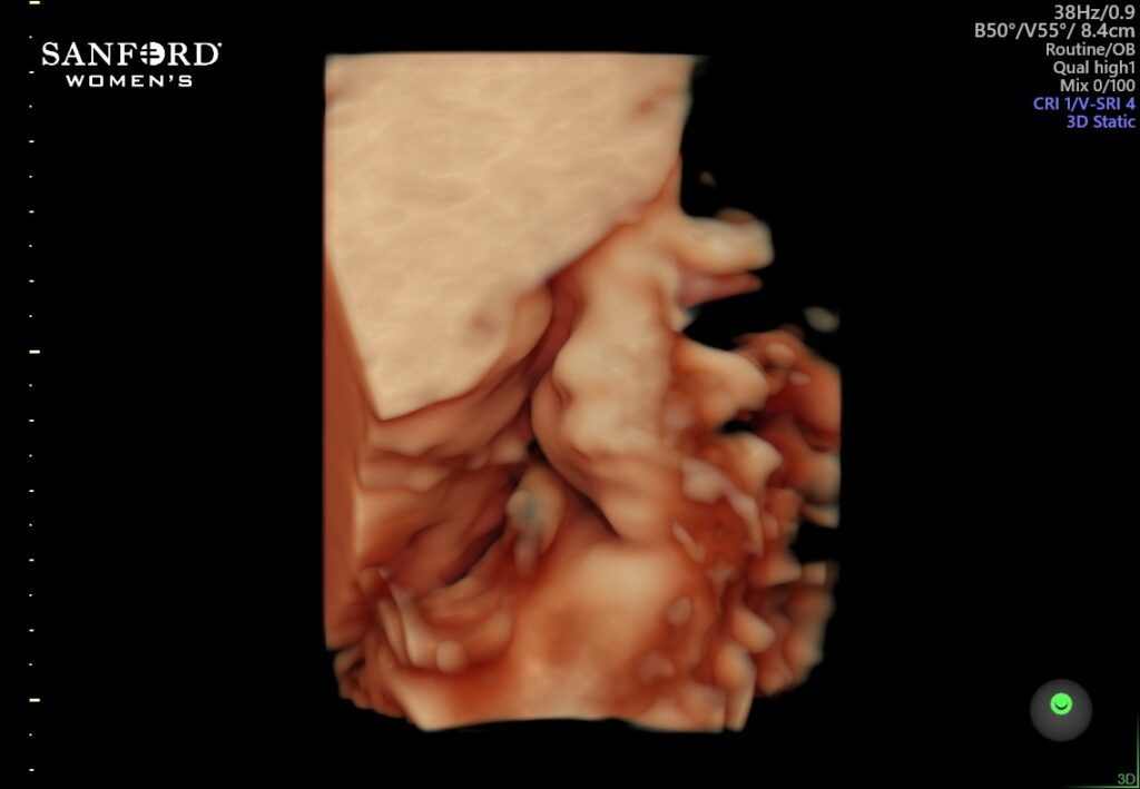 Ultrasound of Wesley Klongerbo in utero